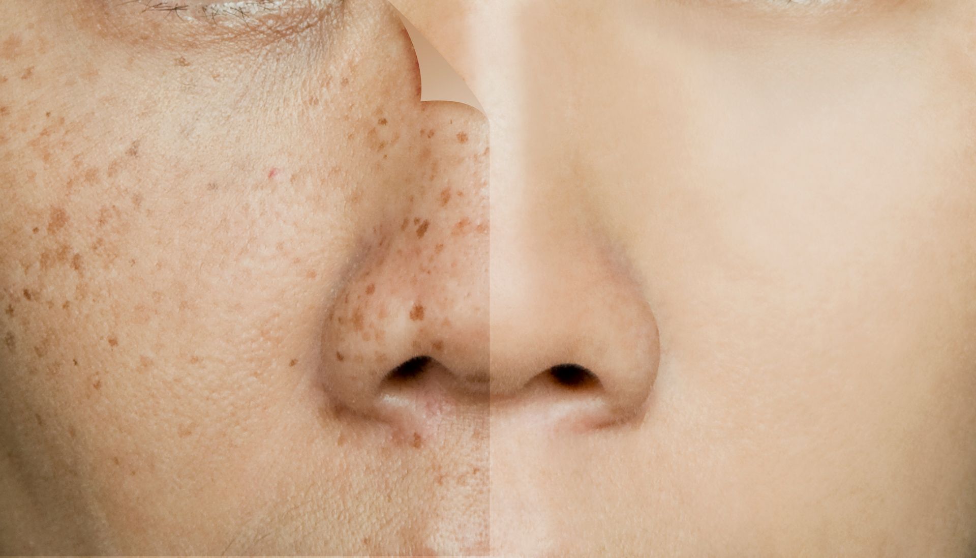 Comparison of a face with uneven skin tone and one with a smooth, even complexion.