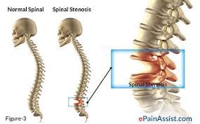 Physical Therapy as Effective as Surgery for Stenosis