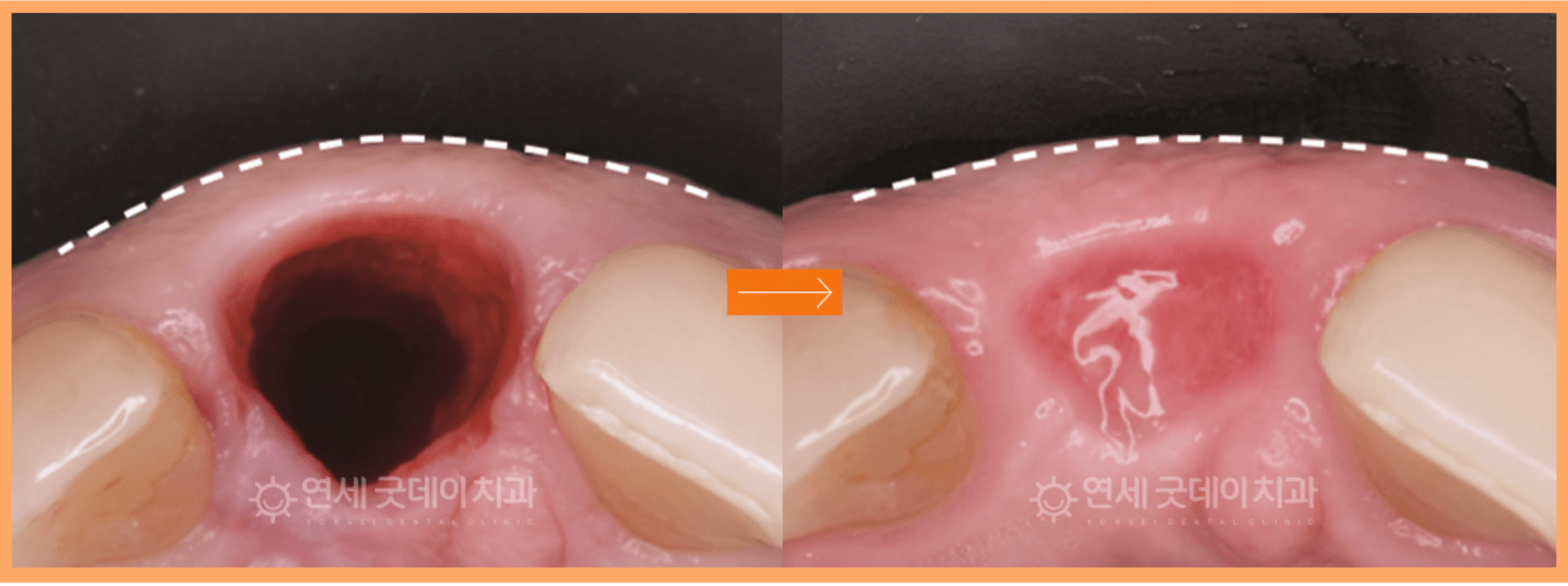 Dental images side-by-side. The left shows a dark oral cavity; the right shows a pink, healing cavity.