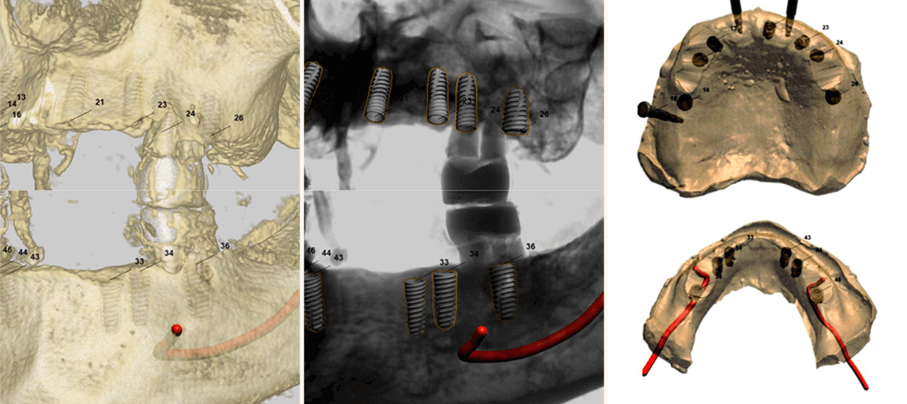 Three dental procedure views: 3D bone scan, X-ray, and model with implant locations marked, depicting jaw bone and dental implants.