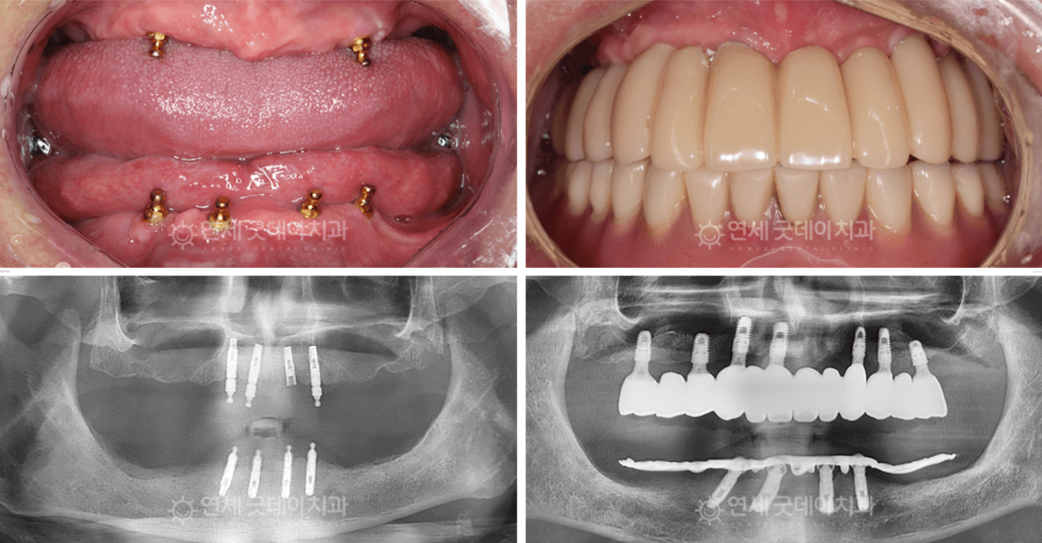 Top row: mouth with dental implants, then completed teeth. Bottom row: dental x-rays of the implants.