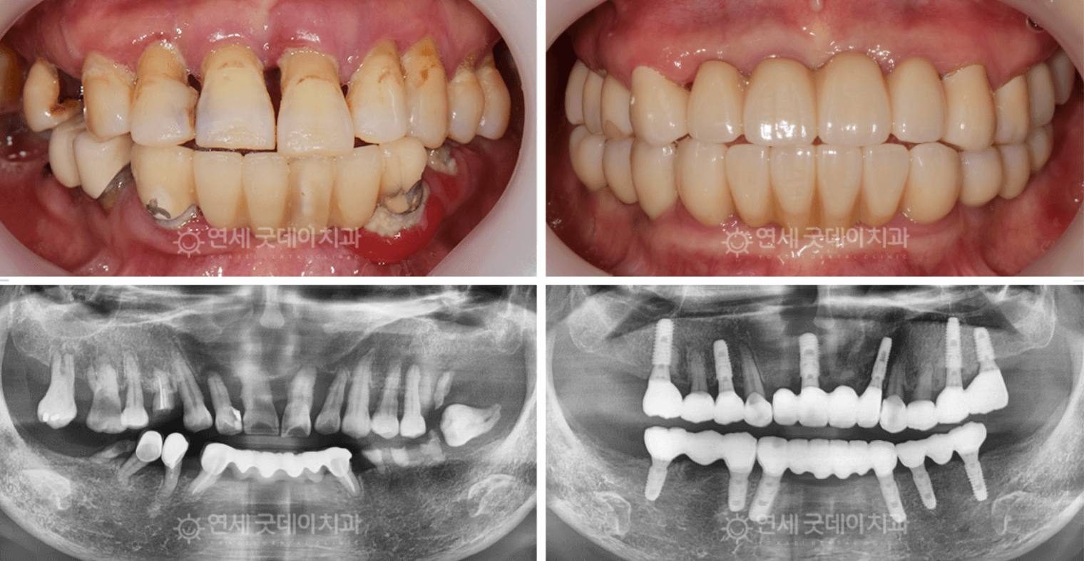 Upper left: damaged teeth, lower left: dental x-ray of damaged teeth. Upper right: restored teeth, lower right: dental x-ray of restored teeth.