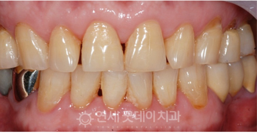 Close-up view of human teeth, some yellowed and worn, with one gold crown.