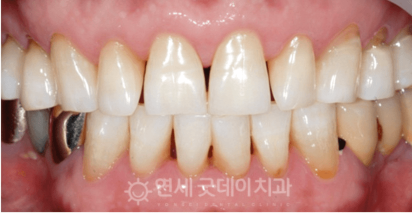 Close-up of teeth; some are discolored and uneven, with receding gums.