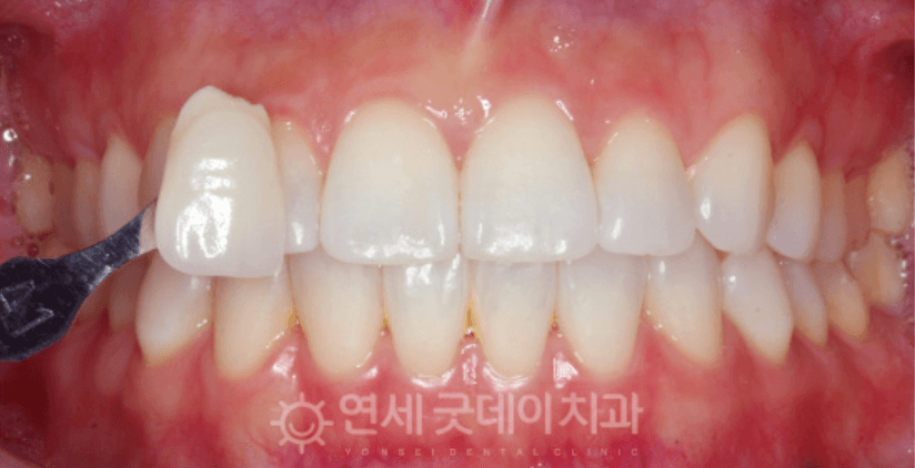 Dental teeth whitening comparison: a shade guide is next to a front tooth.