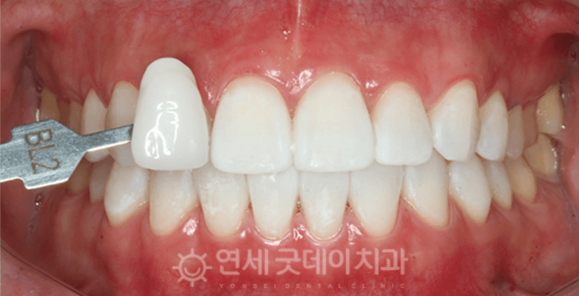 Teeth with a shade guide labeled BL2. The front tooth is a bright white compared to the others.