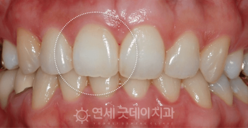 Close-up of human teeth, front view, the central incisor circled in white. The teeth are white, and the gums are pink.