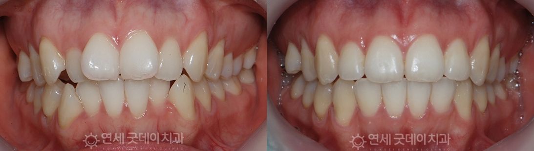 首爾江南牙齒排列前後對比：左邊歪黃，右邊整齊潔白。
