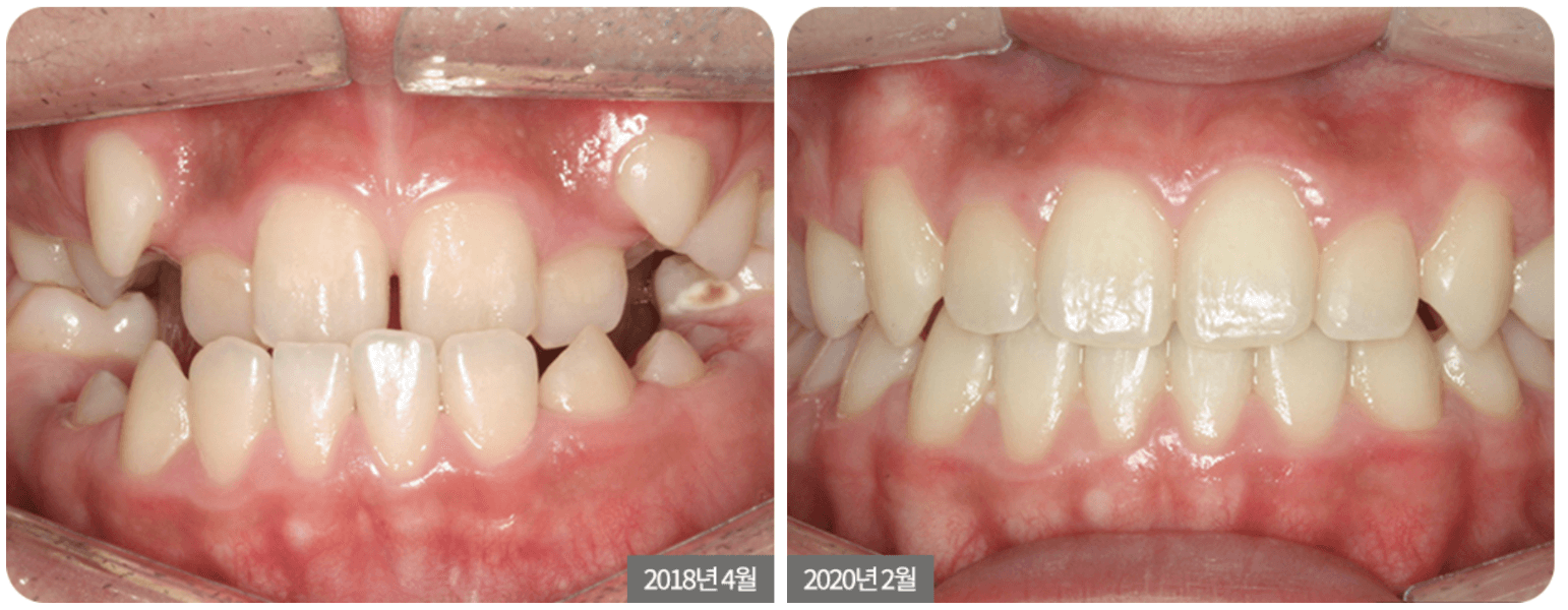 Two views of teeth, one before and one after orthodontic treatment. The