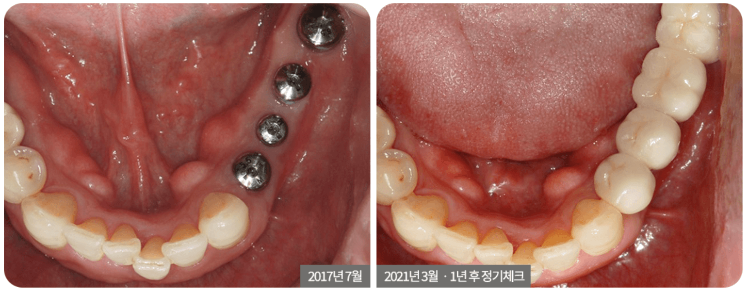 Dental view: implants on the left, completed teeth on the right, within the mouth. Red gums with white teeth.