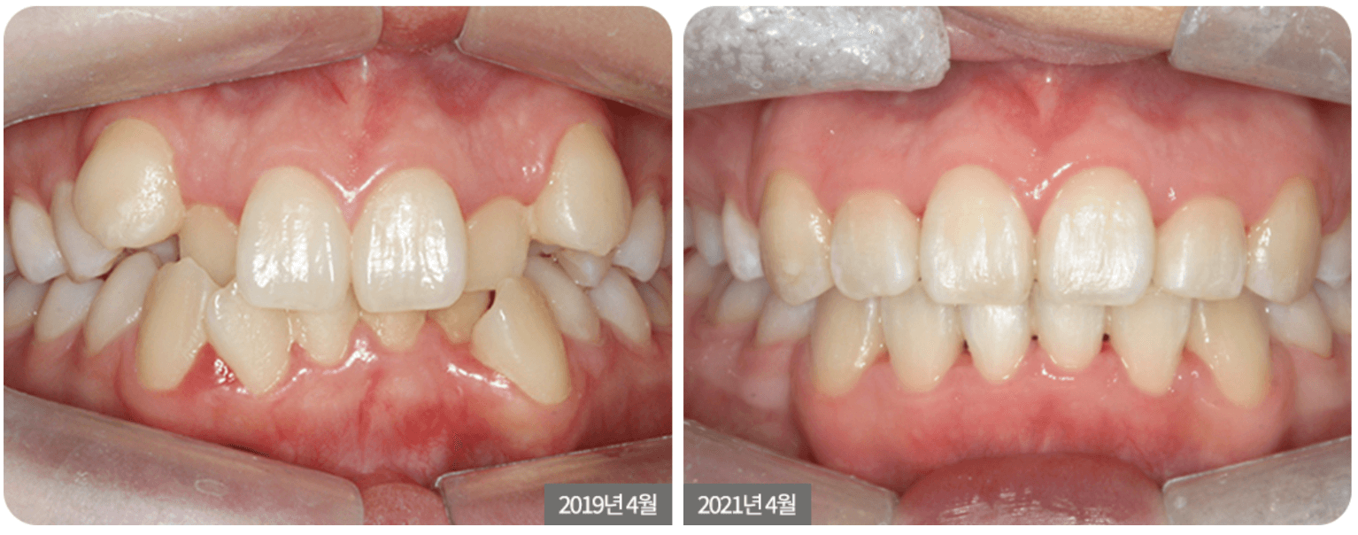Two sets of teeth. The first shows teeth with overbite, the second shows straighter teeth, post-orthodontic treatment.
