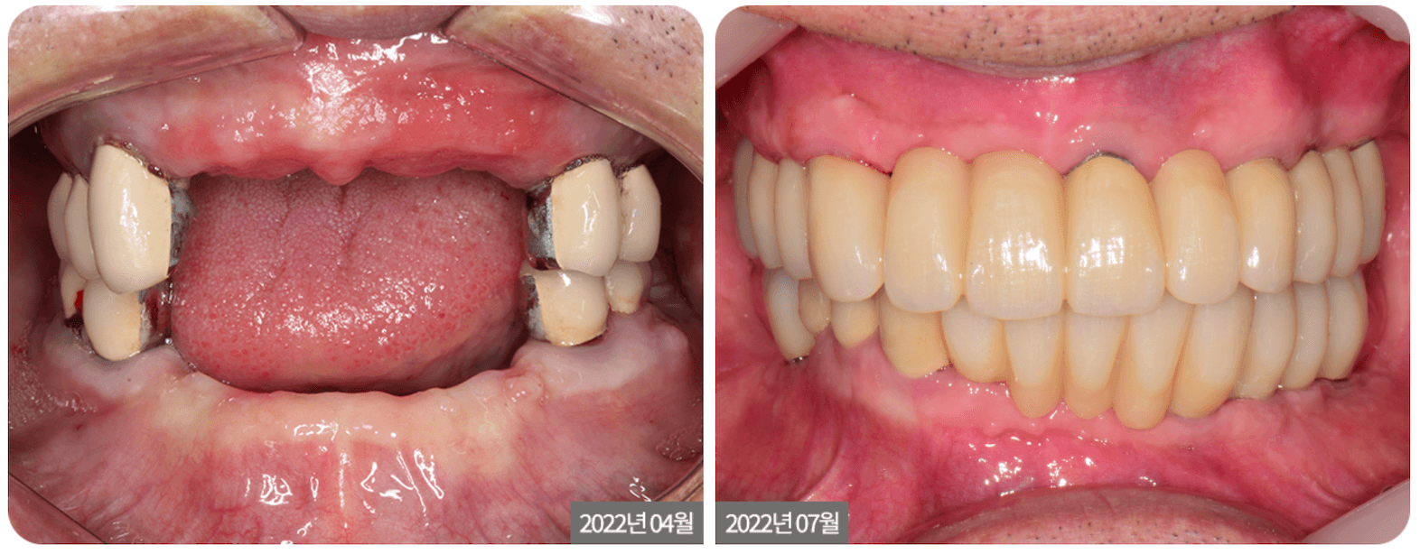 Before and after of dental work: damaged teeth on the left, replaced by a full set of healthy, white teeth on the right.