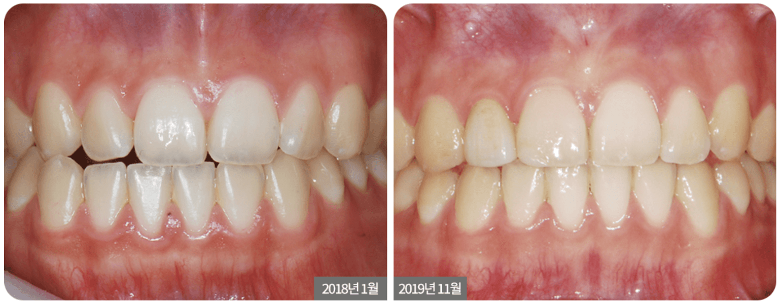 Two side-by-side images of a person's teeth before and after an unspecified dental procedure. The 