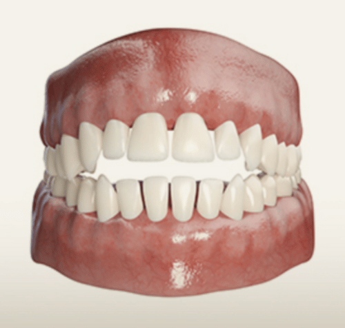 A rendering of human teeth, showing a gap between the front teeth. The gums are red, and the teeth are white.