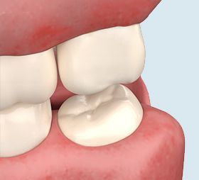 Close-up of a lower molar tooth partially covered by gum, showing its chewing surface in a mouth.