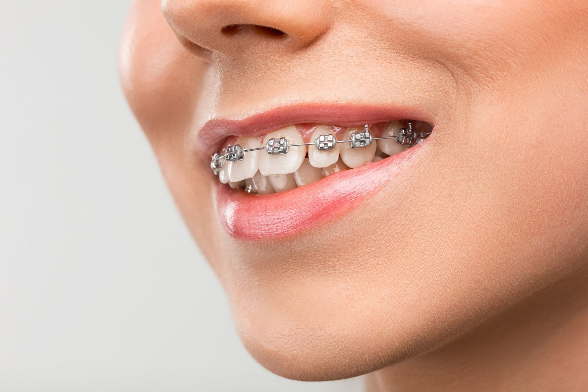 A close up of a woman 's mouth with braces on her teeth.