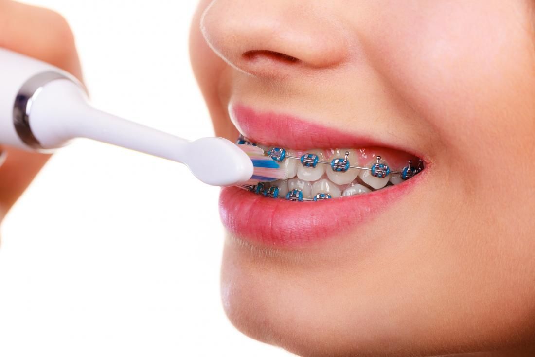 A woman with braces is brushing her teeth with an electric toothbrush.