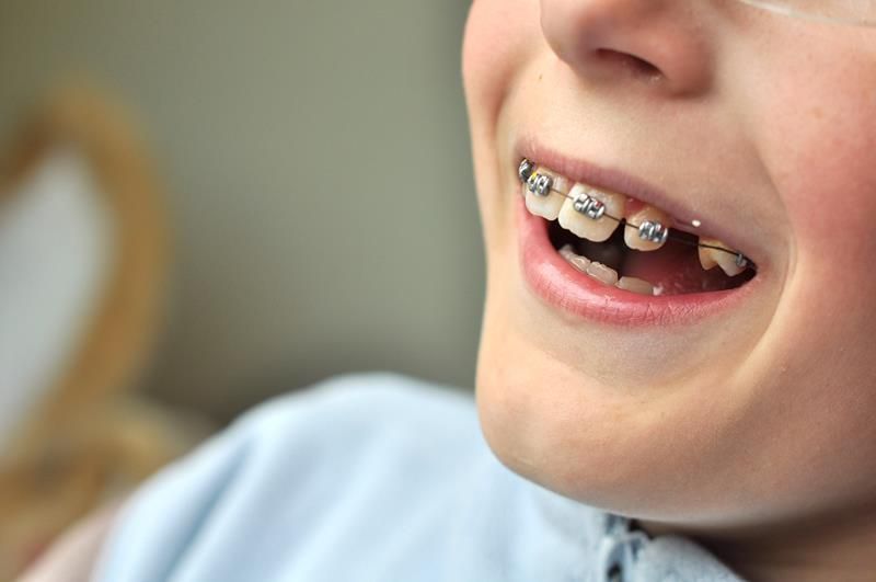 A close up of a child 's mouth with braces on his teeth.