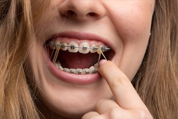 Person with braces smiling, pulling an elastic band between teeth with a finger.