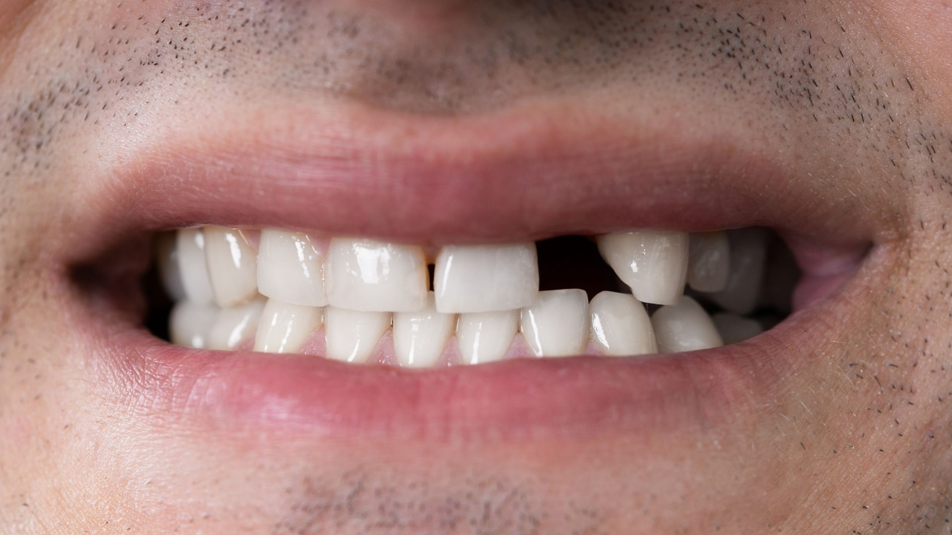 Close-up of a person's mouth with a missing tooth and chipped adjacent tooth; other teeth are white.