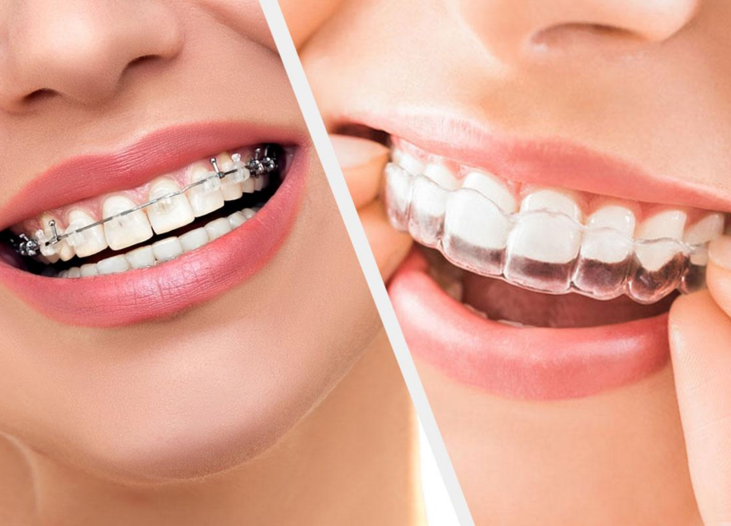 A woman with braces on her teeth and a woman with clear braces on her teeth.