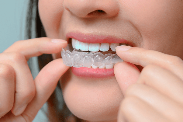 A woman is putting a clear brace on her teeth.