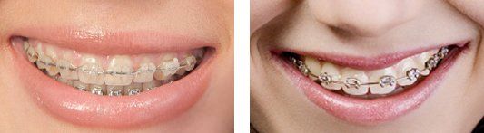 types-of-adult-braces