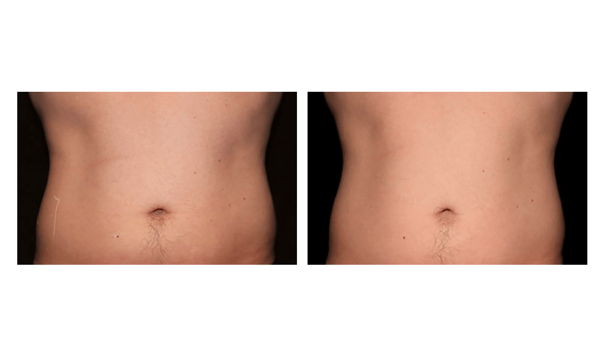 Plaza Med Spa Kansas City Body Sculpting KC Body Contouring