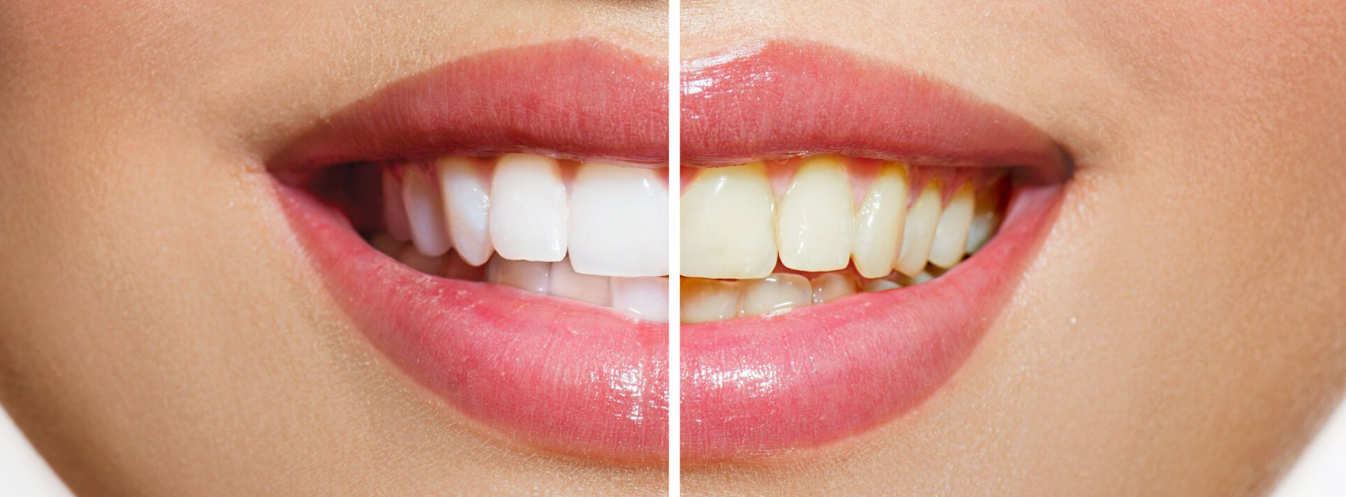 Whitening before and after