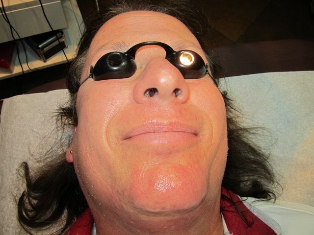 Man wearing protective goggles, undergoing a facial procedure. Sitting on a reclined surface, lit from above.
