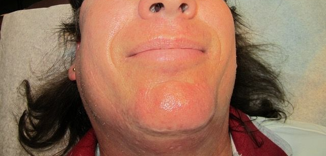 Close-up of a person's face with a red/pinkish substance covering the skin. The person is lying down with dark hair visible.