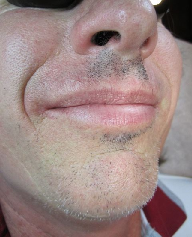 Close-up of a person's mouth, nose, and part of face. Skin is light-toned; a dark mustache and stubble are visible.