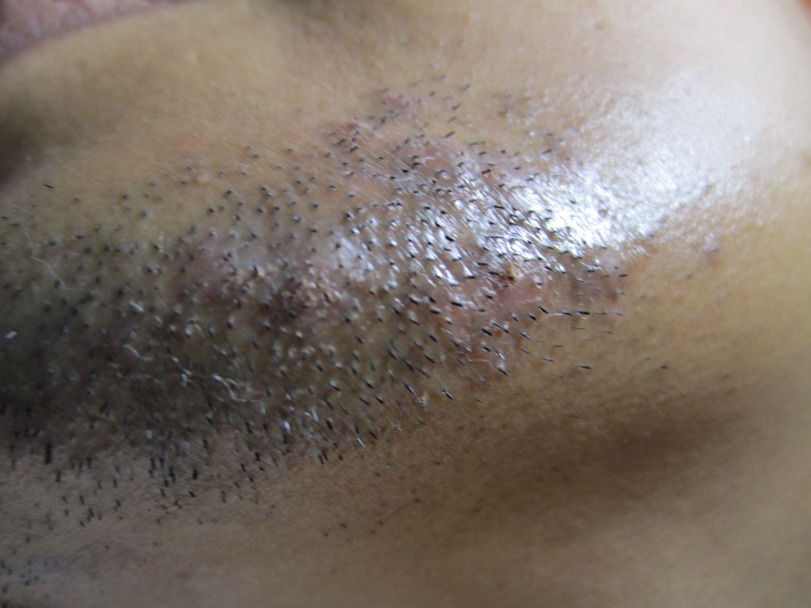 Close-up of a person's shaved chin with stubble and ingrown hairs visible.