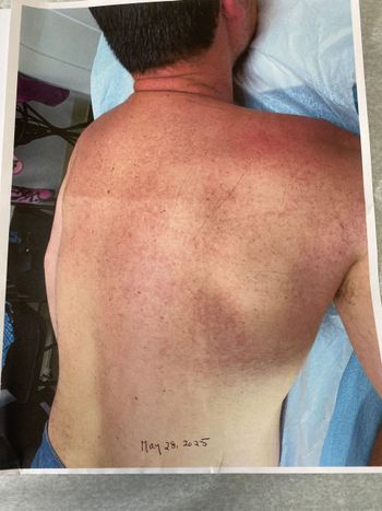 A person's back with a red rash, possibly a skin reaction, on light skin.