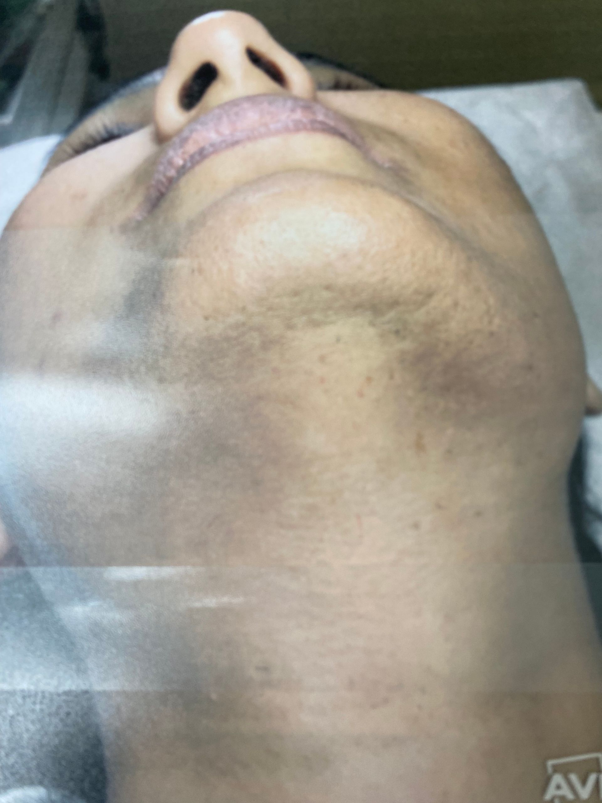 Close-up of a person's face and neck, with a darker pigmentation in the lower face and neck area.