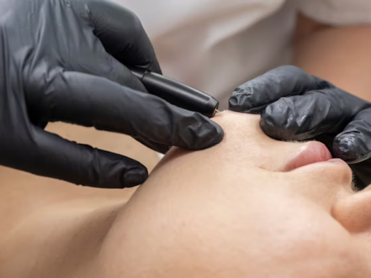Black-gloved hands performing facial procedure with a small tool on a person's nose.