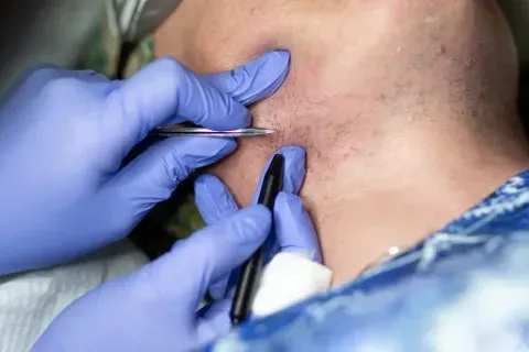 A person's neck being worked on with tweezers and a pen by gloved hands, in a clinical setting.