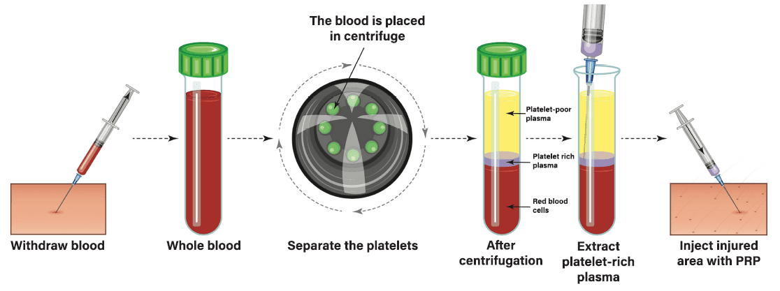 Platelet Rich Plasma