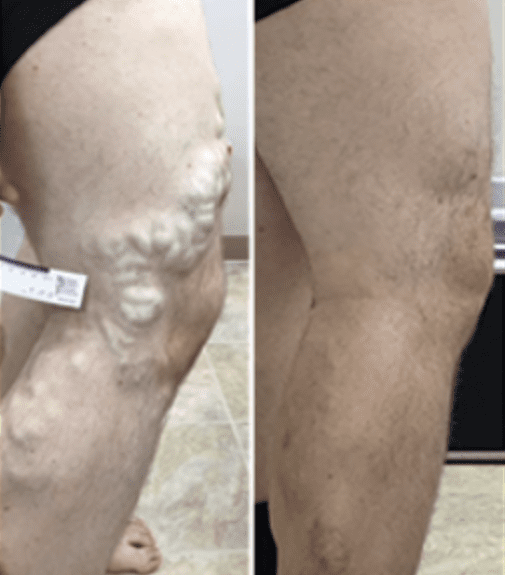 Venous Insufficiency Care