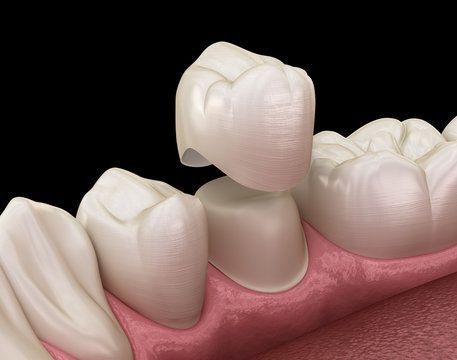 Dental crown placement for tooth restoration in Concord