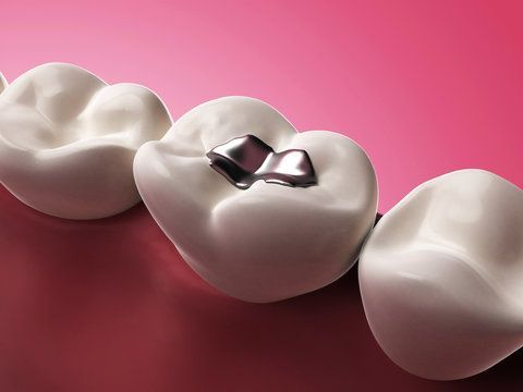 Amalgam fillings for long-lasting cavity repair