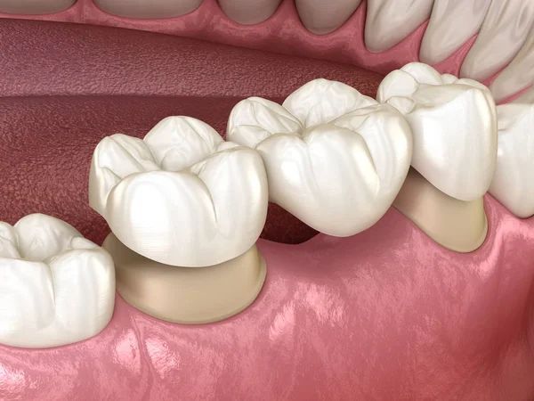 Dental bridges for missing teeth at Central City Dentistry, Concord, NH