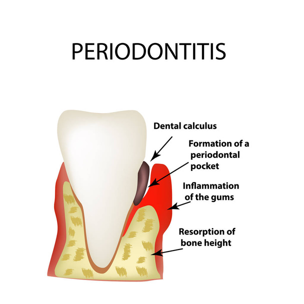 Periodontal maintenance treatment at Central City Dentistry, Concord, NH