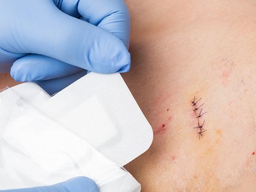 Hands in blue gloves applying a white bandage over a stitched wound on skin.