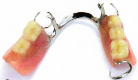 part lower cast metal denture