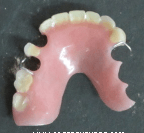 Upper Acrylic Denture
