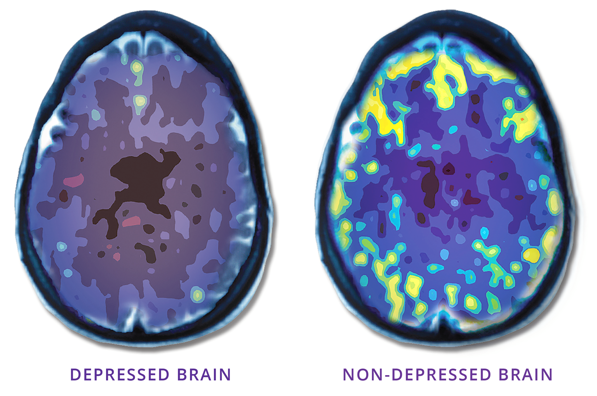 A picture of a depressed brain and a picture of a non-depressed brain