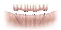 Dental Implant – Dental Practice in Whittier, CA Dental Implant – Dental Practice in Whittier, CA