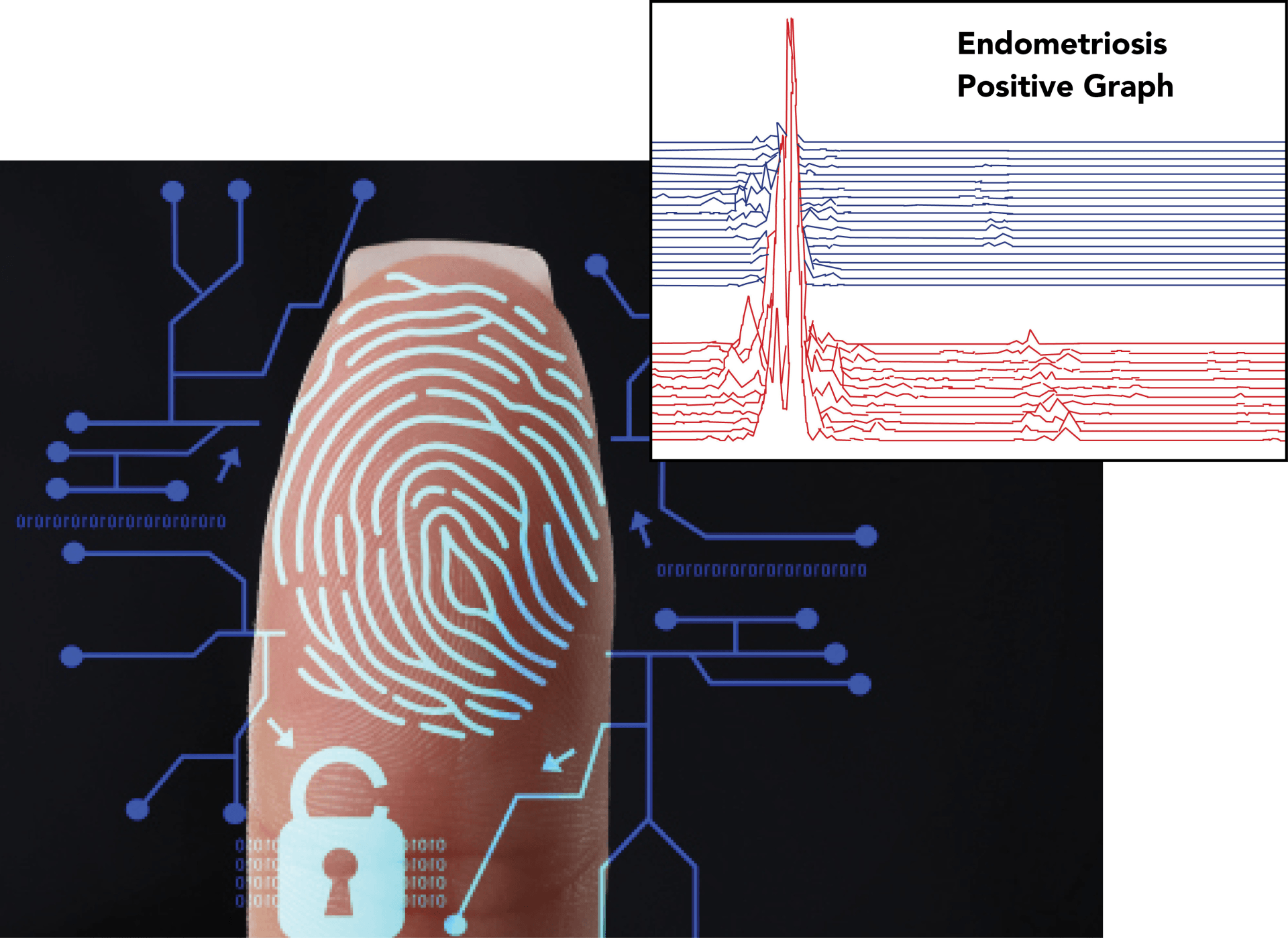 Myoeletric Fingerprint of Endometriosis