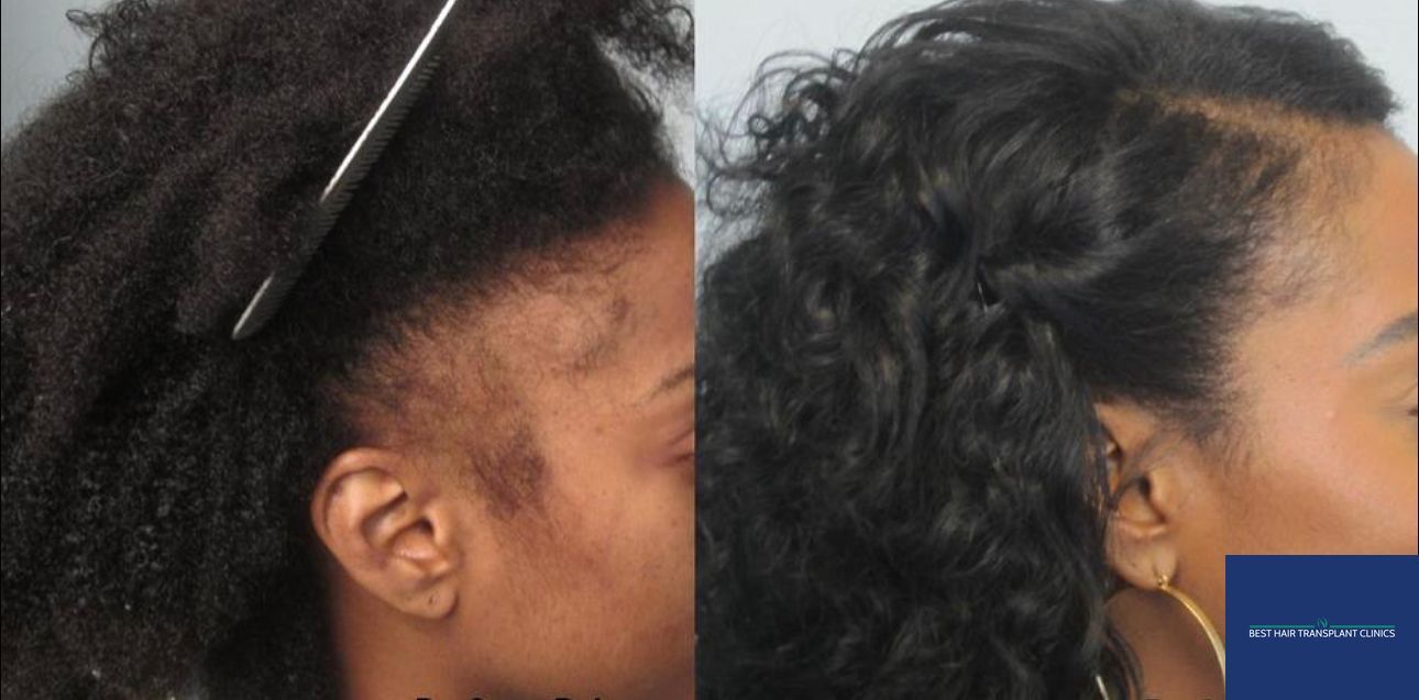 a picture of a male patient after an afro hair transplant with Best Hair Transplant Clinic Liverpool